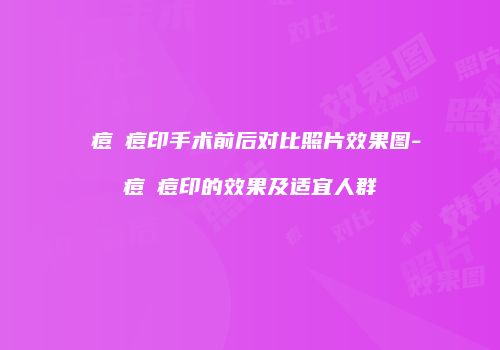 袪痘袪痘印手术前后对比照片效果图-袪痘袪痘印的效果及适宜人群